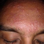 Acne on the forehead