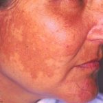 Melasma