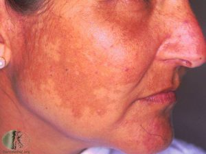 Melasma