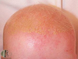 Cradle Cap in an Infant - Seborrheic Dermatitis