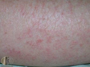 Eczema Craquele (Ateatotic Dermatitis) - Dry Skin