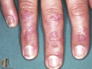 Gottron's Papules of dermatomyositis