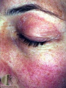 Heliotrope Rash of Dermatomyositis