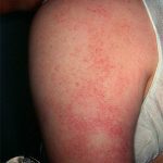 Keratosis Pilaris