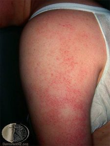 Keratosis Pilaris