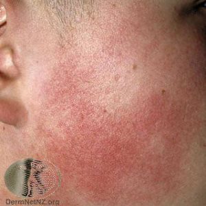 Keratosis Pilaris on the Cheek