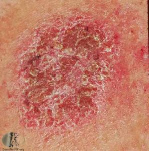 Nummular Dermatitis (Discoid Eczema) - Dry Skin
