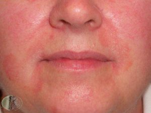 Seborrheic Dermatitis on the Face