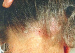 Seborrheic Dermatitis in the Scalp