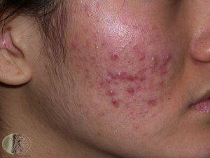 Acne on the cheek