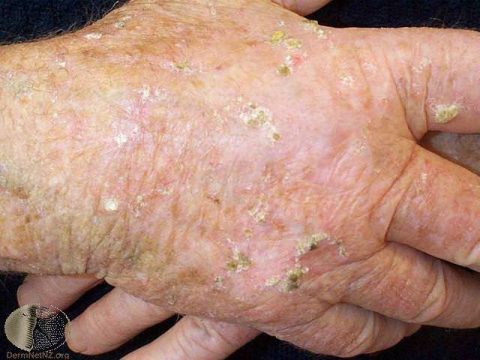 Actinic keratoses on the hands