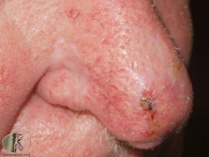 Actinic keratosis on the nose