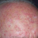 Actinic keratoses on the scalp