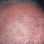 Actinic Keratosis