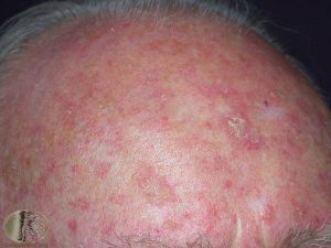Actinic keratoses on the scalp