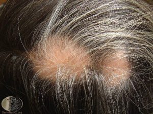 Alopecia Areata - hair loss