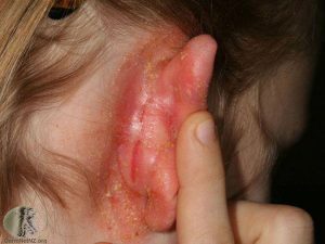 Atopic Dermatitis behind the Ear
