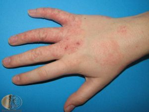 Atopic Dermatitis on the Hand