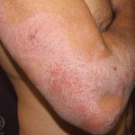 Atopic Dermatitis