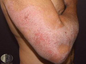 Atopic Dermatitis on the Arm