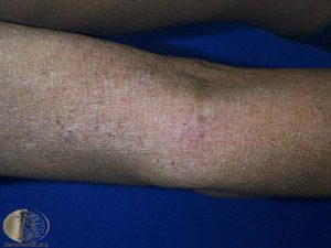 Atopic Dermatitis in the Antecubital Fossa