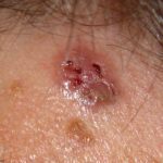 Basal Cell Carcinoma Treatment