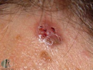 Basal Cell Carcinoma - Skin Cancer