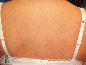 Folliculitis on the Back