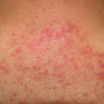 Folliculitis