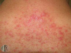 Folliculitis