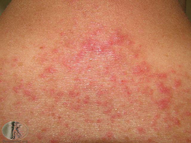 Is Ringworm Contagious?