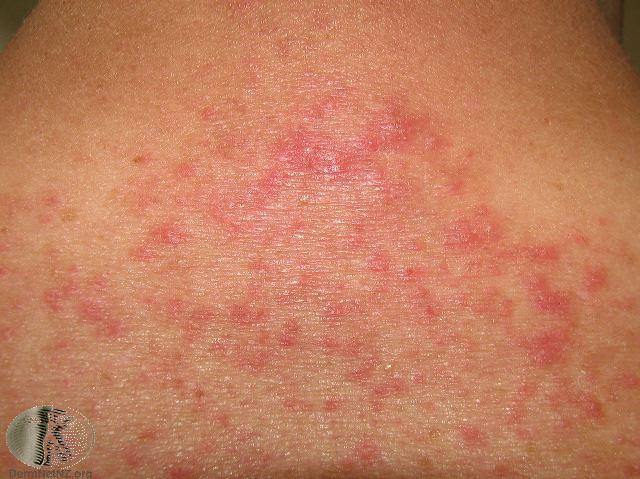 Common Skin Rashes Skin Rash Treatment Colorado Springs Co