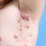 Hidradenitis Suppurativa & Boils Treatment