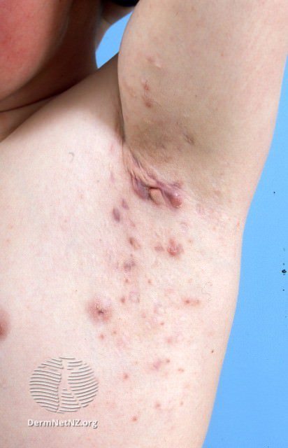 Hidradenitis Suppurativa & Boils Treatment Colorado Springs