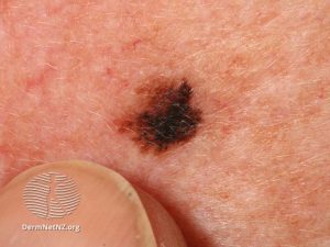 Melanoma in-situ