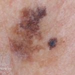 Melanoma Treatment & Information