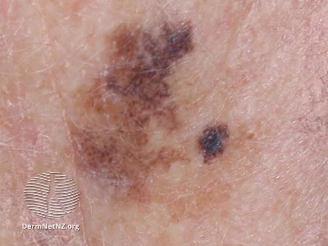 Melanoma Treatment & Information