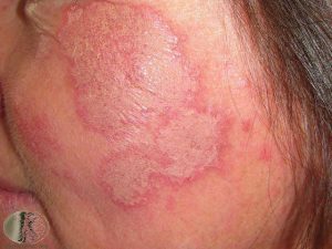 Subacute Cutaneous Lupus