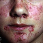 Cutaneous lupus