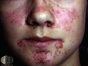 Malar Rash of Systemic Lupus Erythematosus - Cutaneous Lupus