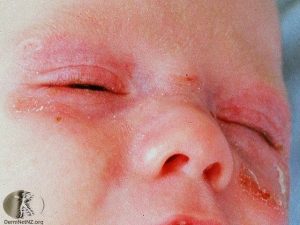 Neonatal Lupus - Cutaneous Lupus
