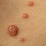 Molluscum Contagiosum