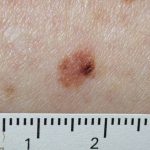 Atypical Melanocytic Nevus