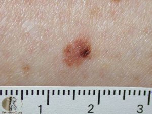 Atypical Melanocytic Nevus - Moles