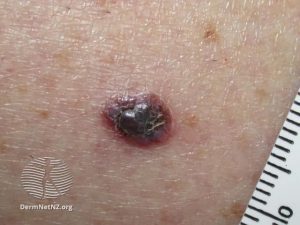 Melanoma - Skin Cancer