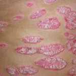 Psoriasis