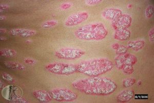 Chronic Plaque Psoriasis
