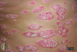 Chronic Plaque Psoriasis