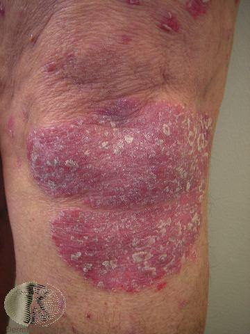Plaque Psoriasis on the Knee