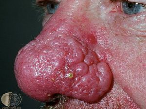 Rhinophyma